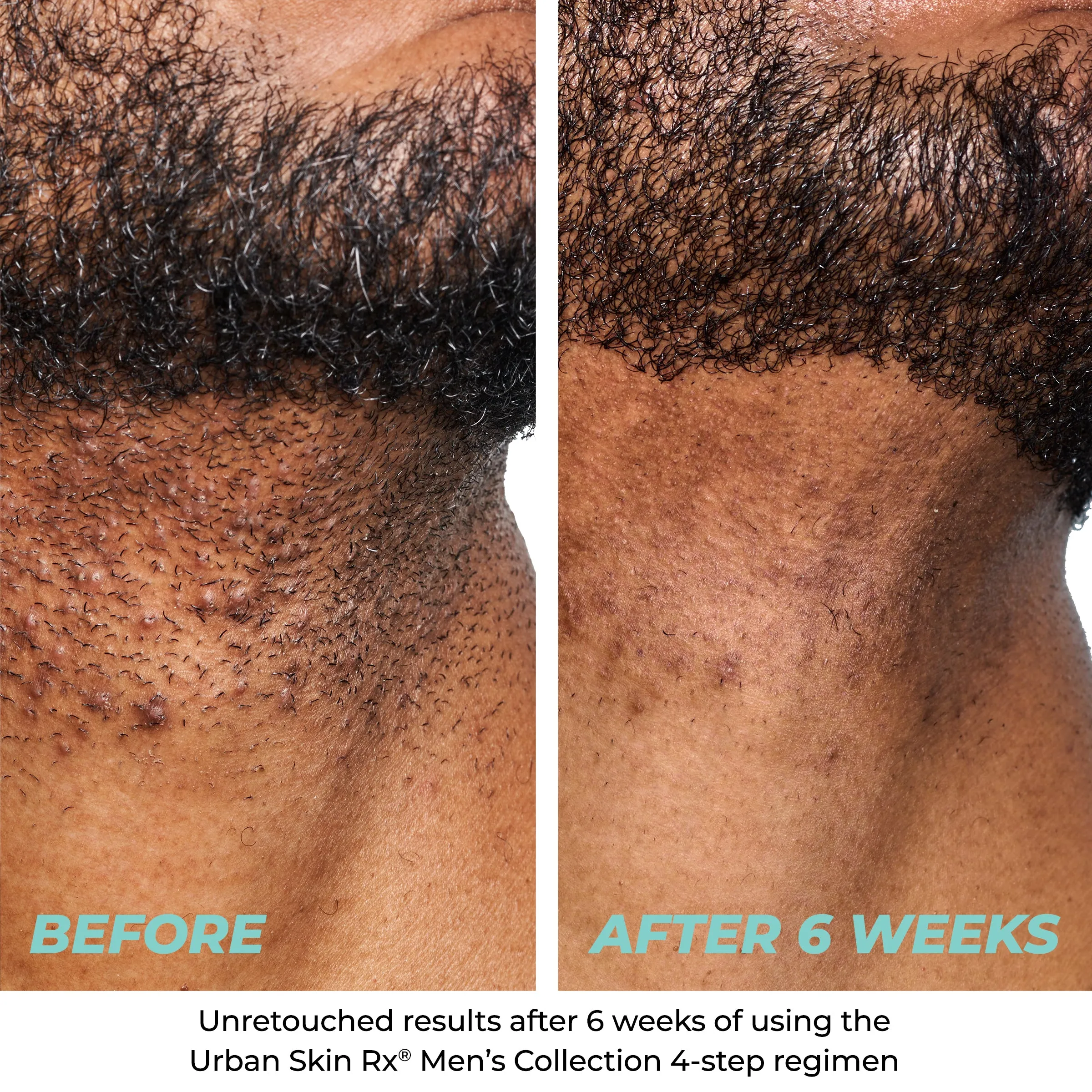 Razor Bump   Dark Spot Treatment